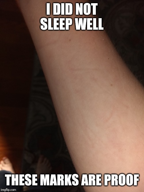 I DID NOT SLEEP WELL; THESE MARKS ARE PROOF | image tagged in sick | made w/ Imgflip meme maker