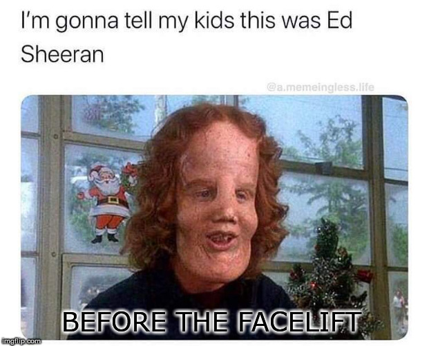 ed sheeran | BEFORE THE FACELIFT | image tagged in first world problems | made w/ Imgflip meme maker