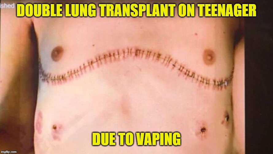 Vaping is worse than cigarettes. | DOUBLE LUNG TRANSPLANT ON TEENAGER; DUE TO VAPING | image tagged in smoking,healthcare | made w/ Imgflip meme maker