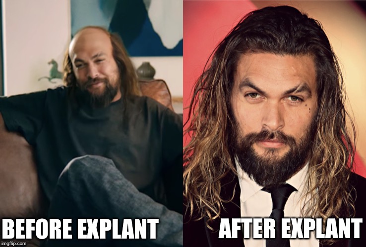 AFTER EXPLANT; BEFORE EXPLANT | image tagged in memes | made w/ Imgflip meme maker