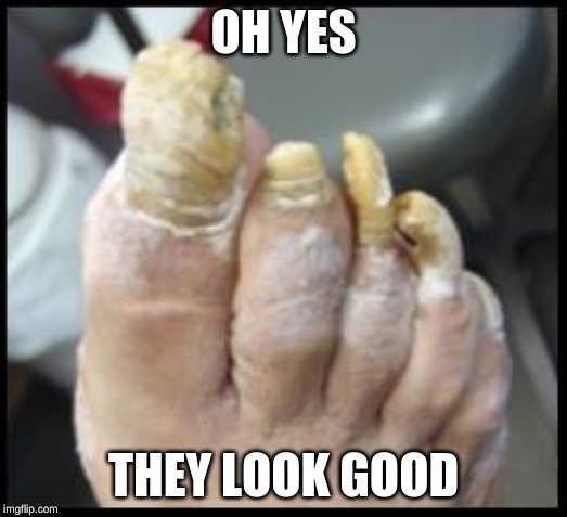 Ugly Toe Nails - Imgflip