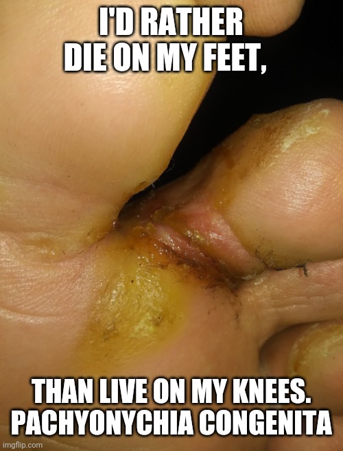 PC | I'D RATHER DIE ON MY FEET, THAN LIVE ON MY KNEES.
PACHYONYCHIA CONGENITA | image tagged in pain,skin,toe | made w/ Imgflip meme maker