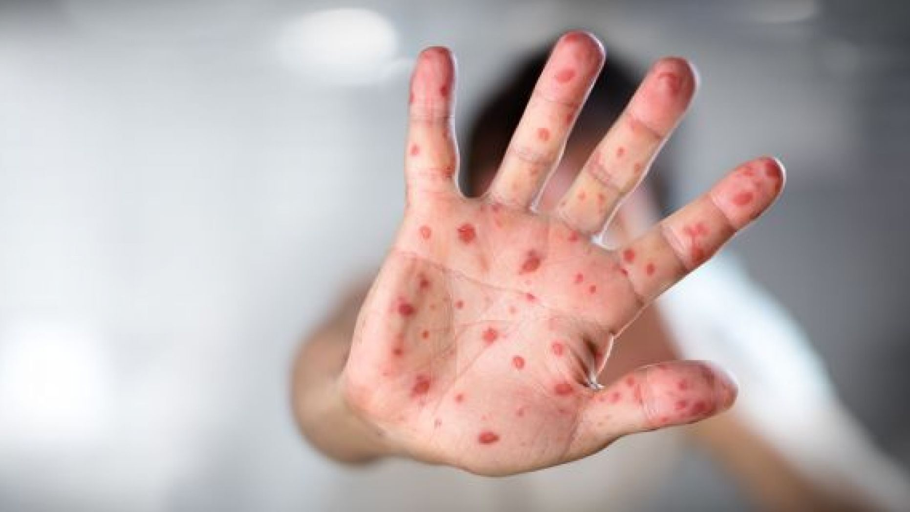 High Quality Child's hand with measles - thank you anti-vaxxers Blank Meme Template