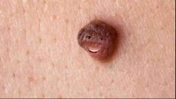 overly attached Wart Meme Template