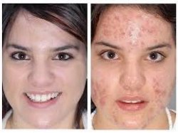 BEFORE AND AFTER ACNE MEME Meme Template