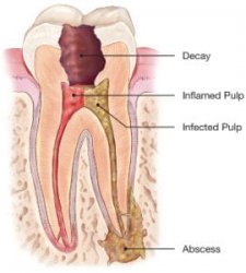 Root Canal Therapy - Mosmandentalclinic.com.au Meme Template