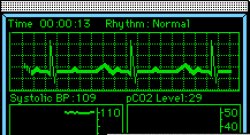 Life and Death EKG Meme Template