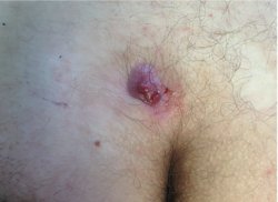 Anal Lesion - ass lesion Meme Template
