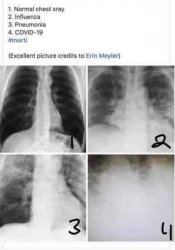 X-Rays - Normal, Flu, Pneumonia, COVID Meme Template