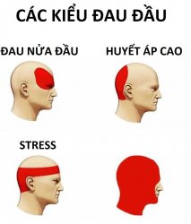Types Of Headache - Vietsub Meme Template