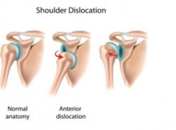 Shoulder dislocation meme Meme Template