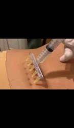 5 needles simultaneously Meme Template
