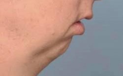 weak chin Meme Template