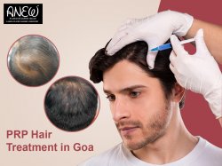 PRP Hair Treatment in Goa - Anew Meme Template