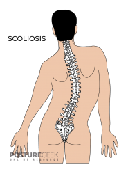 Scoliosis - POSTURE GEEK Meme Template