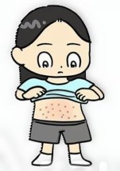 girl with eczema Meme Template