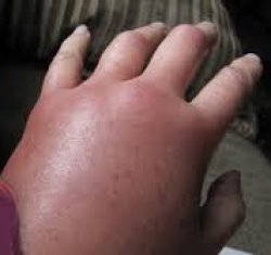 Swollen Hand Meme Template