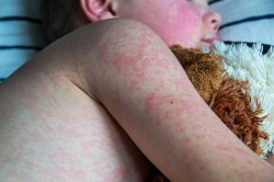 measles child Meme Template