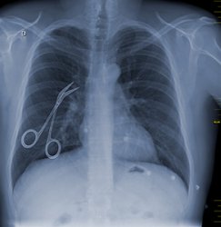 hemostat on chest xray Meme Template