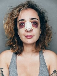 woman black eyes broken nose abused Meme Template