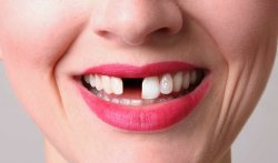 Woman missing tooth and smiling Meme Template