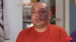 Man with Birth Mark on Face Meme Template
