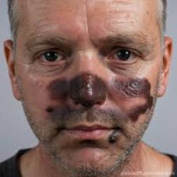 Man with Birth Mark on Face Meme Template