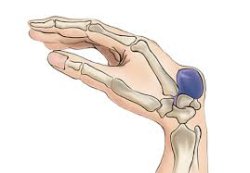 ganglion Meme Template