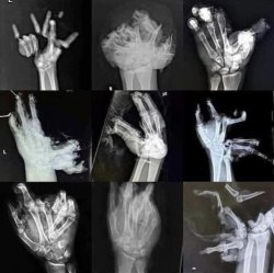 Hand fractures Meme Template