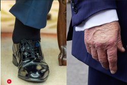 Trump cankles and bruised hand makeup Meme Template