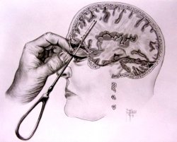 Time for a lobotomy Meme Template