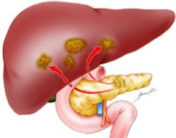 pancreatic cancer Meme Template