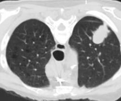 Lung cancer Meme Template