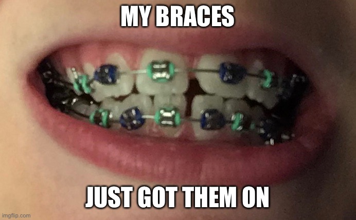Sorry for the horrible photo quality | MY BRACES; JUST GOT THEM ON | image tagged in braces | made w/ Imgflip meme maker