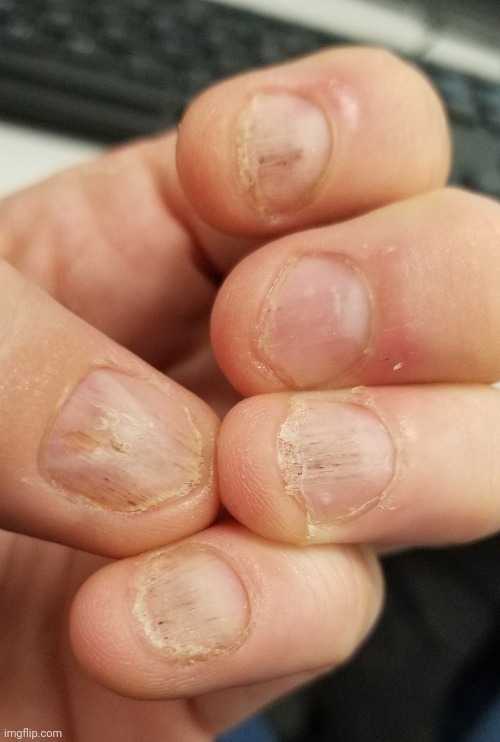 I have been biting fingernails for so long. They are finally growing