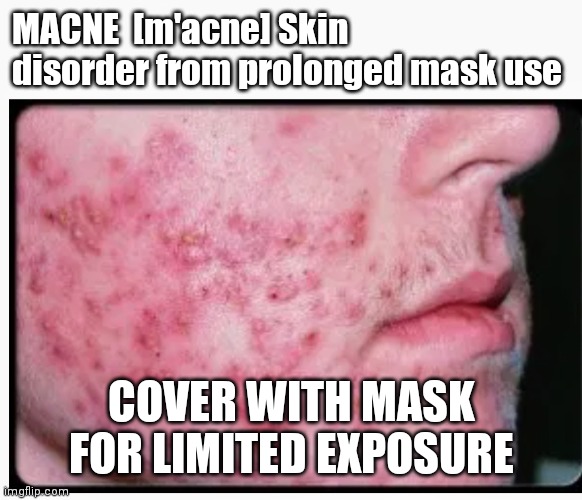 MACNE Mask-Acne | MACNE  [m'acne] Skin disorder from prolonged mask use; COVER WITH MASK FOR LIMITED EXPOSURE | image tagged in masks | made w/ Imgflip meme maker