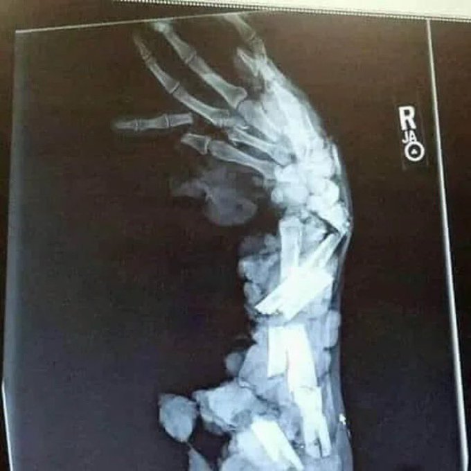 arm of a dem after a maga Blank Meme Template