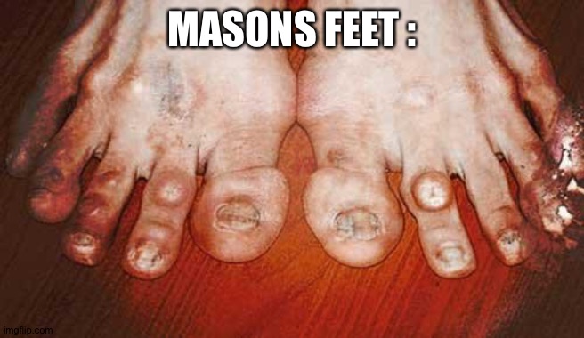 Masons ugly foot | MASONS FEET : | image tagged in ugly feet | made w/ Imgflip meme maker