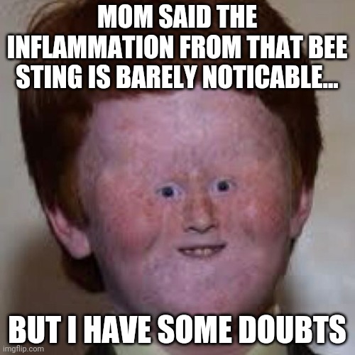 Moms.....they do lie | MOM SAID THE INFLAMMATION FROM THAT BEE STING IS BARELY NOTICABLE... BUT I HAVE SOME DOUBTS | image tagged in weird face kid,mom | made w/ Imgflip meme maker