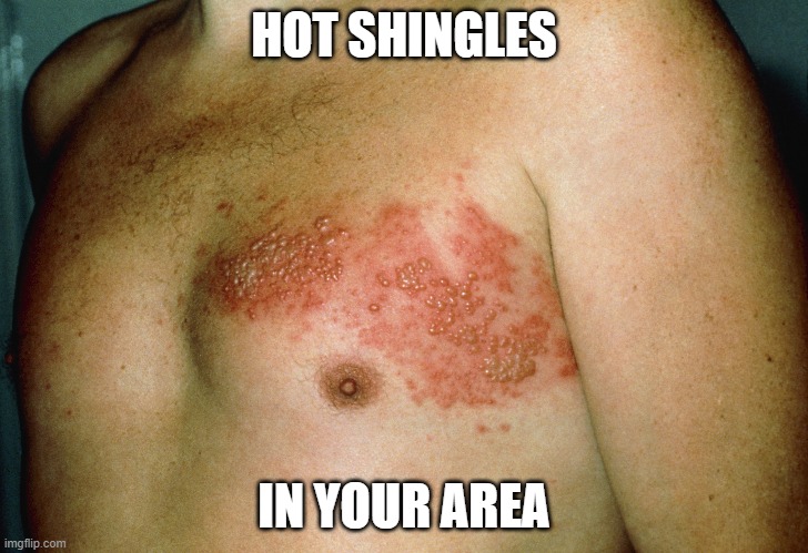 Hot Shingles | HOT SHINGLES; IN YOUR AREA | image tagged in hot shingles,hot singles,in your area | made w/ Imgflip meme maker