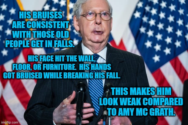 Why Is He Hiding The Facts? | HIS BRUISES ARE CONSISTENT WITH THOSE OLD PEOPLE GET IN FALLS. HIS FACE HIT THE WALL, FLOOR, OR FURNITURE.  HIS HANDS GOT BRUISED WHILE BREAKING HIS FALL. THIS MAKES HIM LOOK WEAK COMPARED TO AMY MC GRATH. | image tagged in politics | made w/ Imgflip meme maker