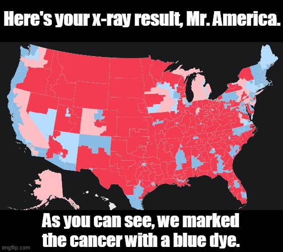 America: Doctor, doctor, how long do I have left? Doctor: Maybe another 4 years | Here's your x-ray result, Mr. America. As you can see, we marked the cancer with a blue dye. | image tagged in usa,house map,cancer,maga2020,democrats,purge | made w/ Imgflip meme maker