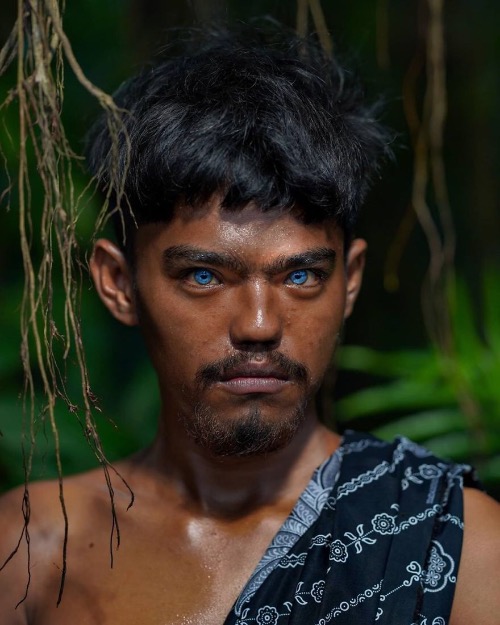 Blue Eyes Caused By Waardenburg Syndrome. Photo credit: Korchnoi Pasaribu | image tagged in awesome,pics,photography | made w/ Imgflip meme maker