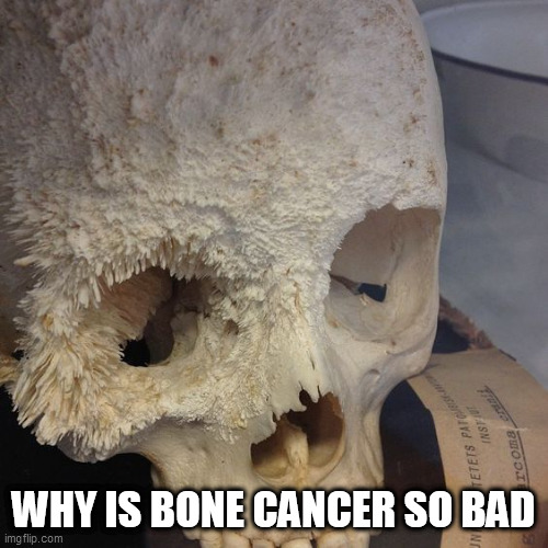Bone cancer | WHY IS BONE CANCER SO BAD | image tagged in bone cancer | made w/ Imgflip meme maker
