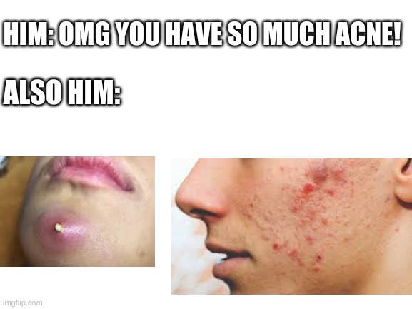 Pimple Faced Boys be like... |  HIM: OMG YOU HAVE SO MUCH ACNE! ALSO HIM: | image tagged in blank white template,acne,pimples,boys,teen | made w/ Imgflip meme maker