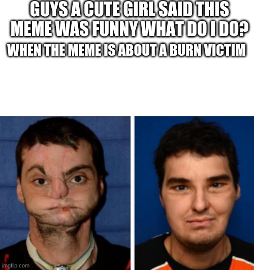 Children can be asses | GUYS A CUTE GIRL SAID THIS MEME WAS FUNNY WHAT DO I DO? WHEN THE MEME IS ABOUT A BURN VICTIM | image tagged in before and after burn victim | made w/ Imgflip meme maker