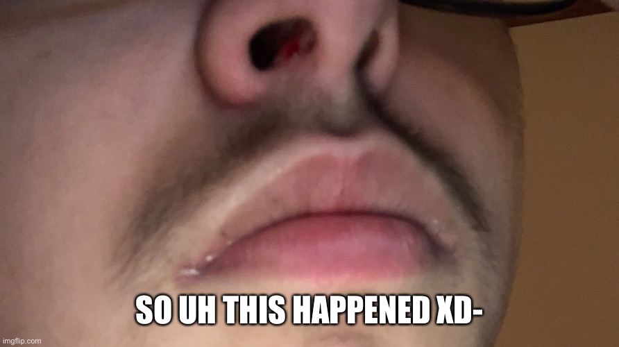 My nose is bleeding | SO UH THIS HAPPENED XD- | made w/ Imgflip meme maker