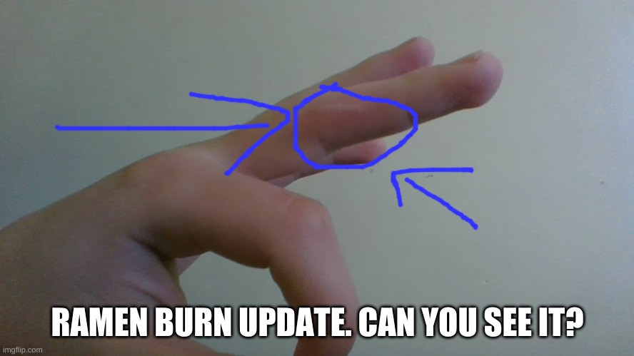 ramen burn update | RAMEN BURN UPDATE. CAN YOU SEE IT? | made w/ Imgflip meme maker