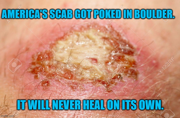 We Are Infected. | AMERICA'S SCAB GOT POKED IN BOULDER. IT WILL NEVER HEAL ON ITS OWN. | image tagged in politics | made w/ Imgflip meme maker