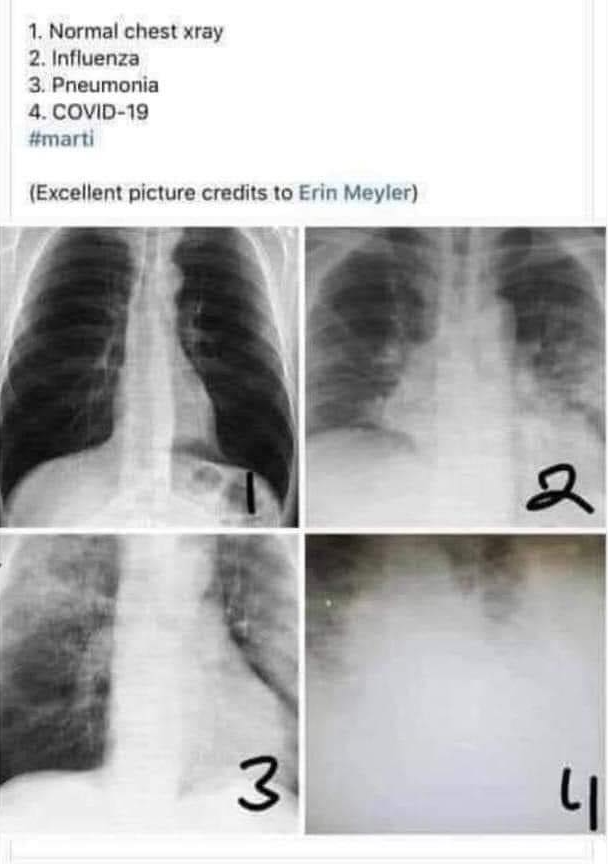 X-Rays - Normal, Flu, Pneumonia, COVID Blank Meme Template